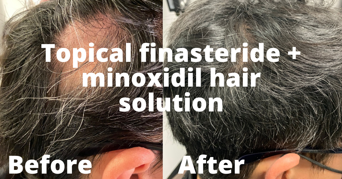 Topical Hair Loss Solution | Topical Finasteride & Minoxidil | RejuvLA
